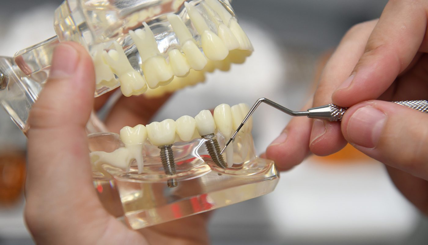 Zahnpraxis Dr. Scheucher Fotos Behandlungen Implantate